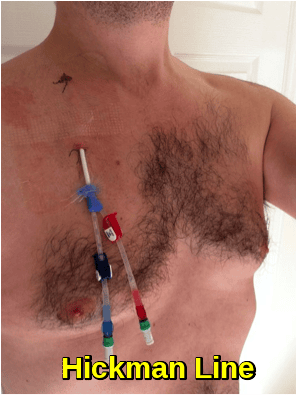 Hickman Line, a type of central venous catheter (CVC) used for the long-term, safe administration of chemotherapy agents.