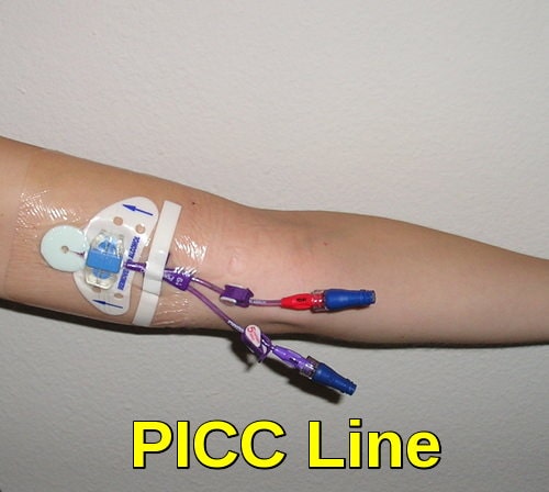 PICC Line (Peripherally Inserted Central Catheter), commonly used for long-term chemotherapy administration and venous access in oncology patients.