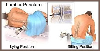 Administration of Intrathecal Chemotherapy into the subarachnoid space for treating CNS involvement in cancer.