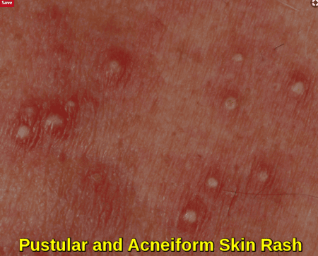 Pustular skin rash, a common dermatological side effect or adverse reaction to specific chemotherapy or targeted agents (e.g., EGFR inhibitors).