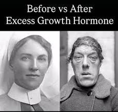 Historical before-and-after photograph showing facial changes caused by acromegaly from excess growth hormone production