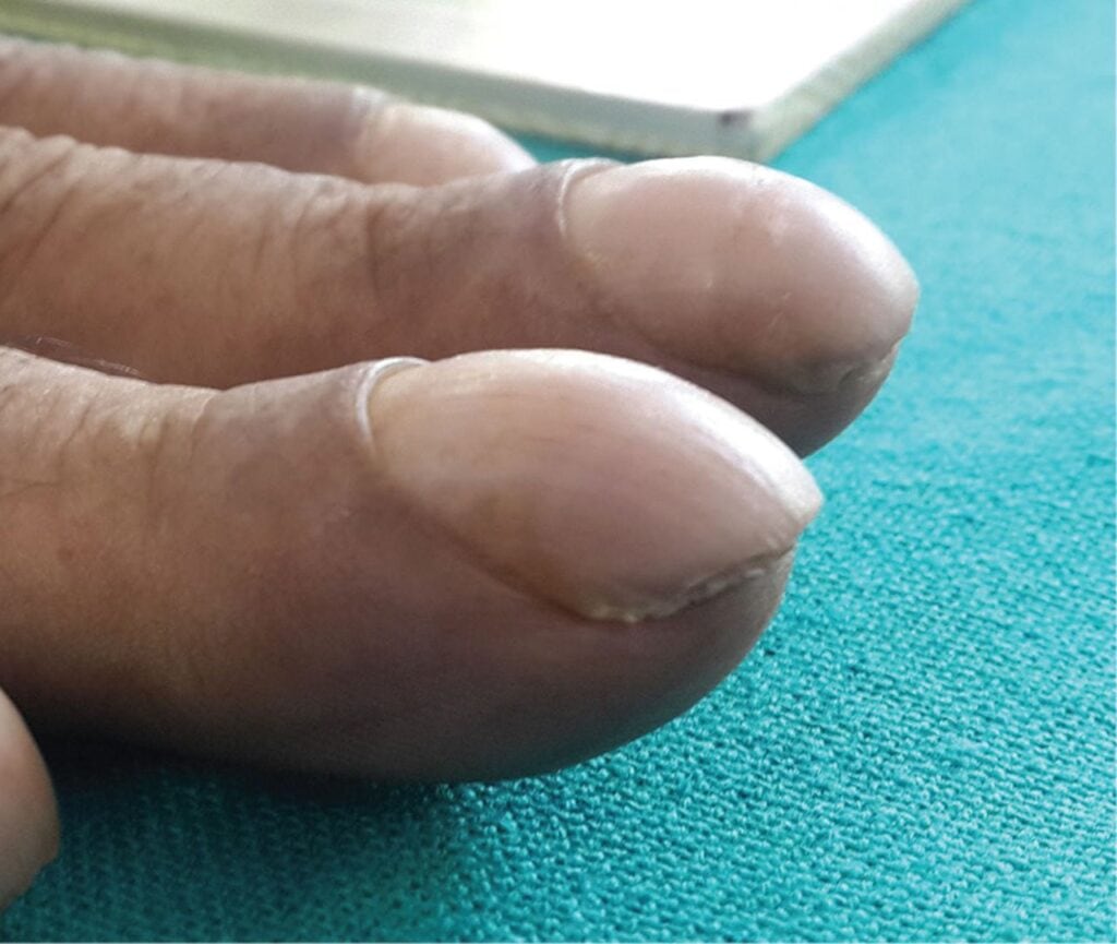 Clinical photograph showing digital clubbing in hypertrophic osteoarthropathy associated with underlying lung cancer