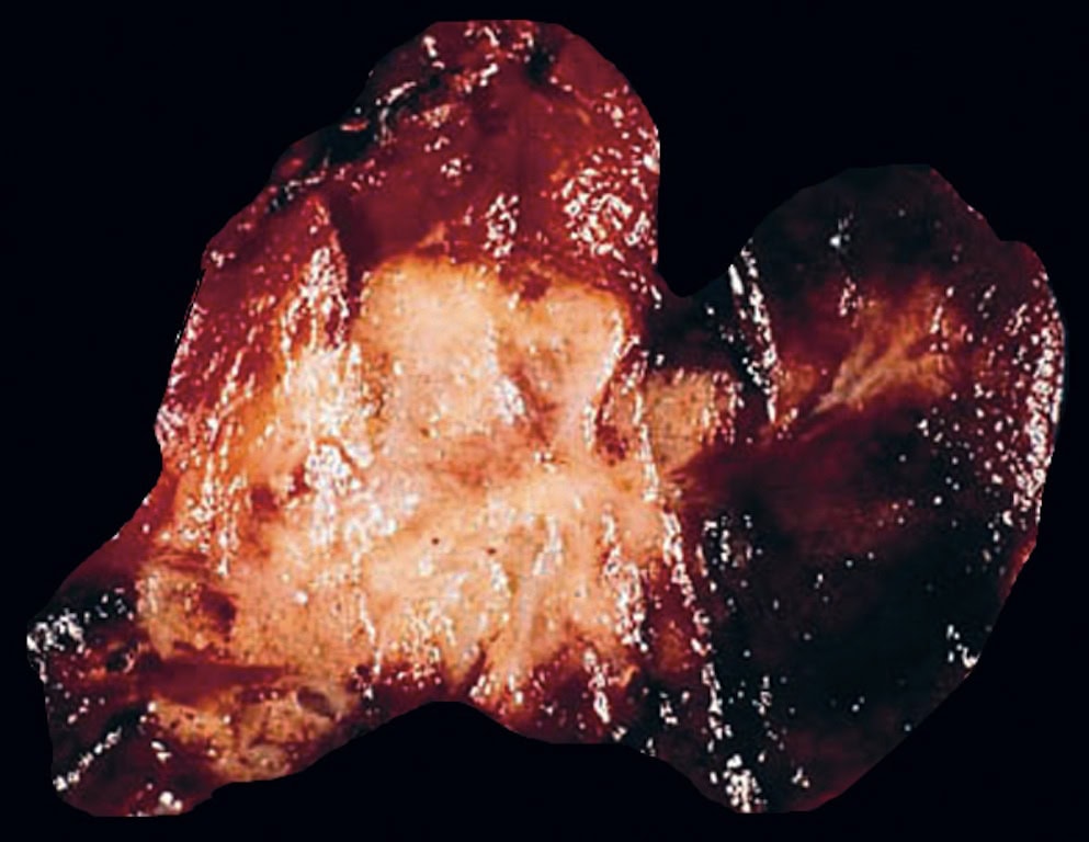 Gross pathology specimen showing medullary thyroid carcinoma involving the thyroid gland