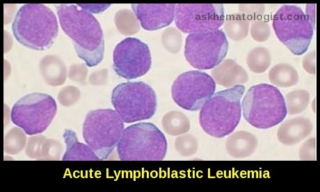 Peripheral blood smear showing lymphoblasts in acute lymphoblastic leukemia