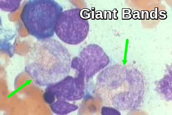 Giant band cell