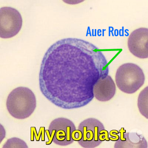 Myeloblast with Auer rods