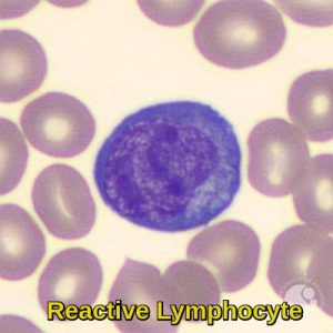 Reactive Lymphocyte