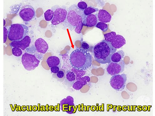 Vacuolated Erythroid Precursor