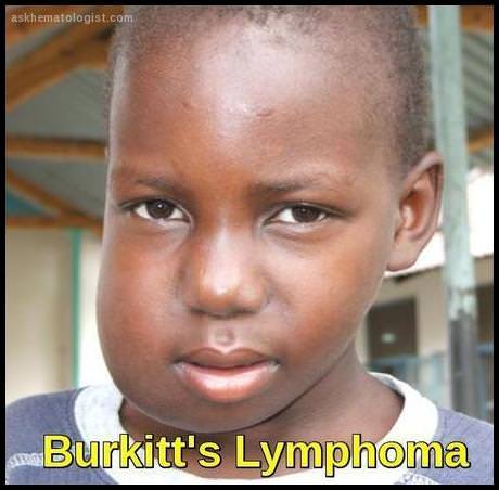 Child with facial swelling due to jaw involvement in Burkitt lymphoma