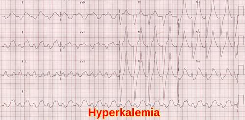 Electrocardiogram showing tall peaked T waves and widened QRS complexes consistent with hyperkalemia