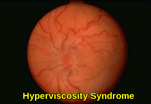 Hyperviscosity Syndrome - Retina