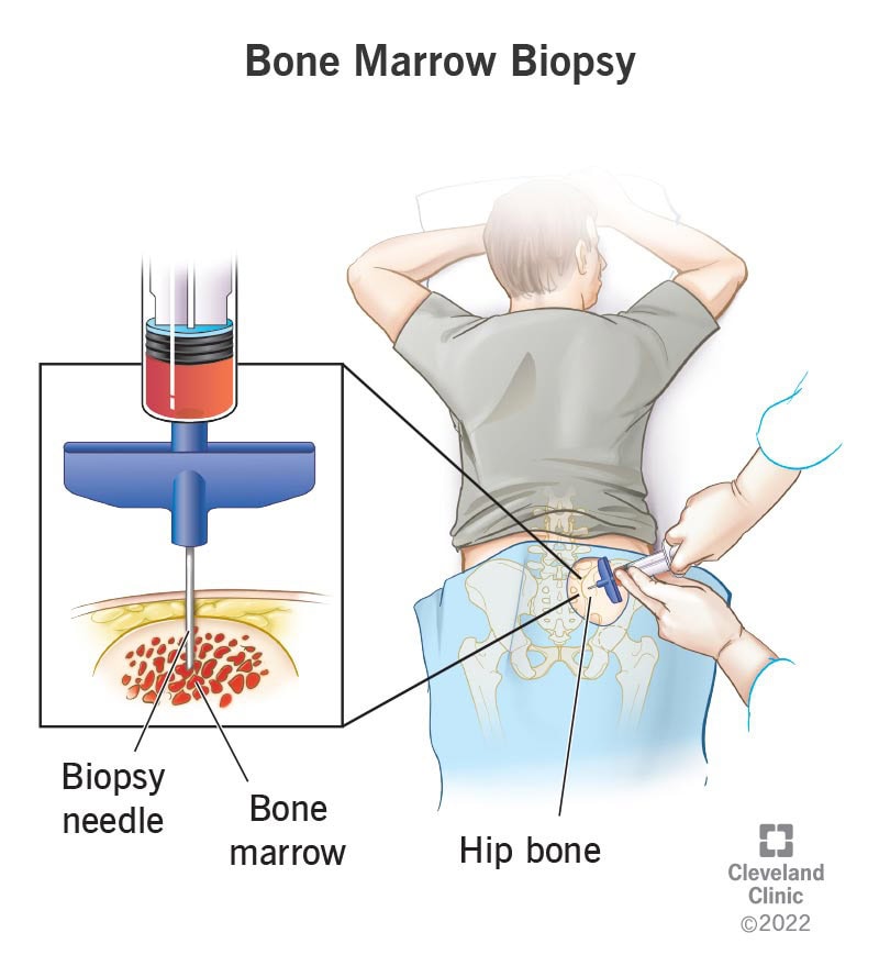 Bone Marrow Examination – Trephine Bone Marrow Biopsy Procedure at the Hip Bone