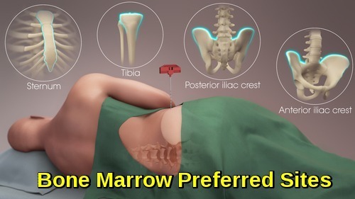 posterior iliac crest bone marrow biopsy