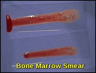 Bone Marrow Aspirate