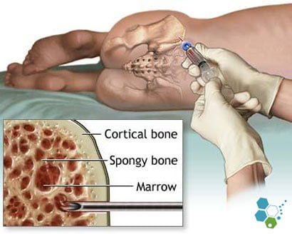 Bone marrow examination showing cortical bone, spongy bone, and bone marrow anatomy