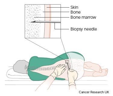 Bone Marrow Examination