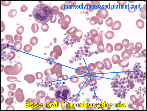 High Platelet Count