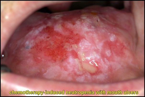 mucositis inducida por quimioterapia