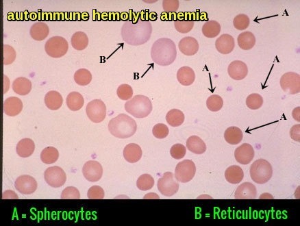 Spherocytes and Reticulocytes