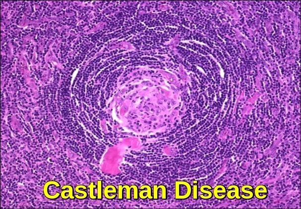 Castleman disease, hyaline vascular type.