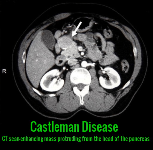 Castleman Disease-Head of Pancreas