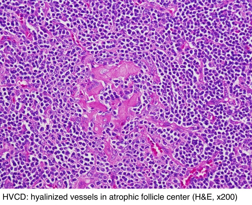 HVCD: hyalinized vessels in atrophic follicle center
