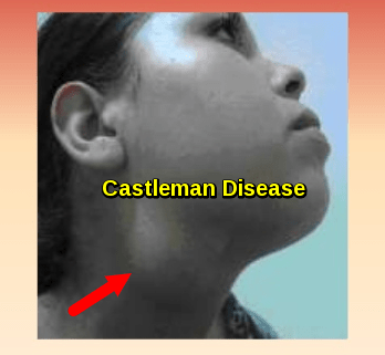 Castleman Disease - Cervical Lymphadenopathy