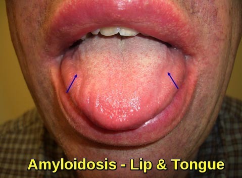 Amyloidosis - Enlarged Tongue