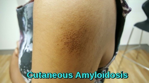 Cutaneous Amyloidosis