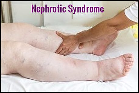 Amyloidosis - Nephrotic Syndrome