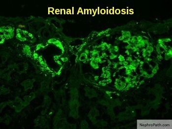 Renal amyloidosis showing apple-green birefringence of amyloid deposits under polarized light