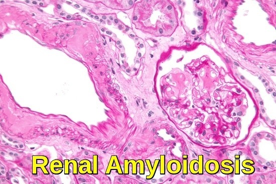 Renal Amyloidosis