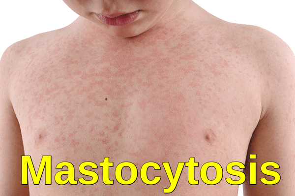 Cutaneous Mastocytosis