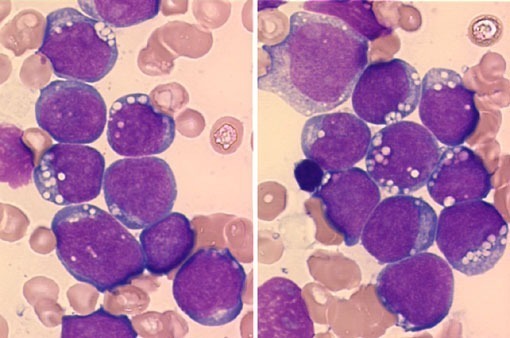 Approach to Lymphocytosis
