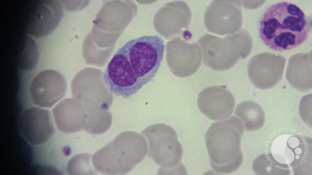Approach to Lymphocytosis