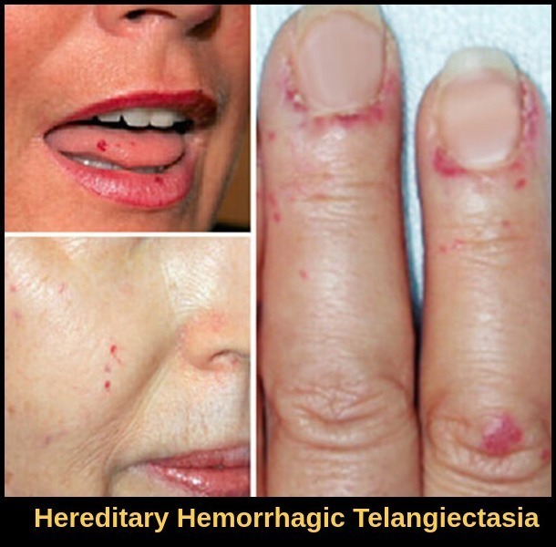 Hereditary Hemorrhagic Telangiectasia