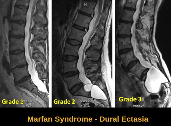 Marfan Syndrome 