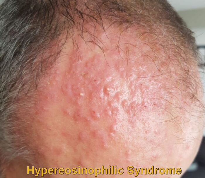 Idiopathic hypereosinophilic syndrome with cutaneous involvement