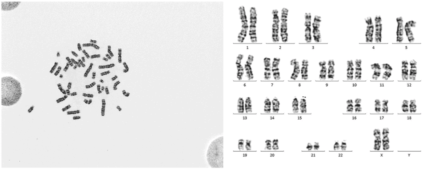 G-banded metaphase chromosomes and corresponding human karyotype analysis G-banding metaphase chromosome spread with corresponding karyotype showing normal chromosomal structure used in cytogenetic analysis in molecular and cytogenetic studies in hematology.