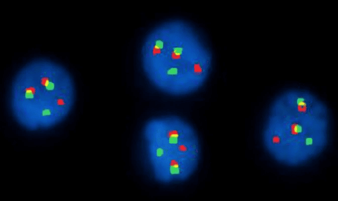 Interphase FISH with IGH/FGFR3 dual-fusion probe showing t(4;14)(p16;q32) in multiple myeloma Interphase FISH using IGH/FGFR3 dual-fusion probes demonstrating the t(4;14)(p16;q32) translocation, with IGH in green and FGFR3 in red, in molecular and cytogenetic studies in hematology.