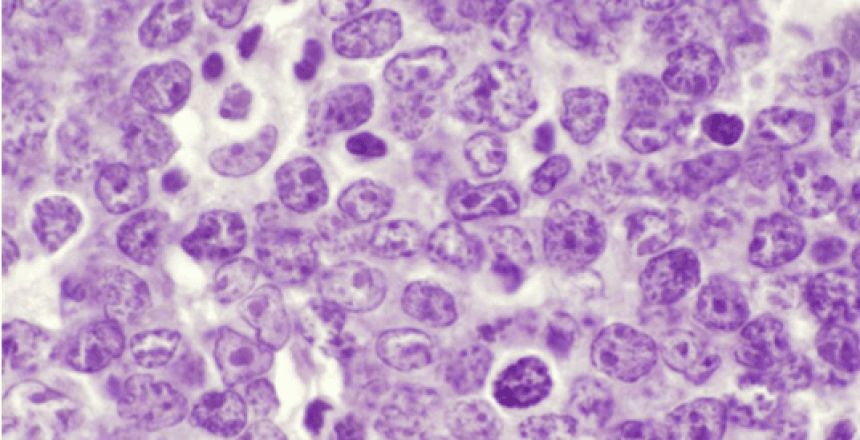 High-power H&E section showing large atypical lymphoid cells with prominent nucleoli characteristic of diffuse large B-cell lymphoma