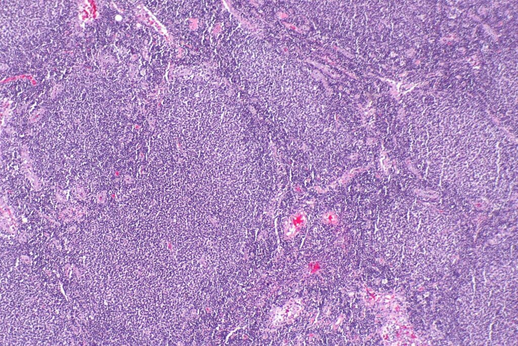 Low-power H&E section of a lymph node demonstrating nodular lymphoid follicles characteristic of follicular lymphoma